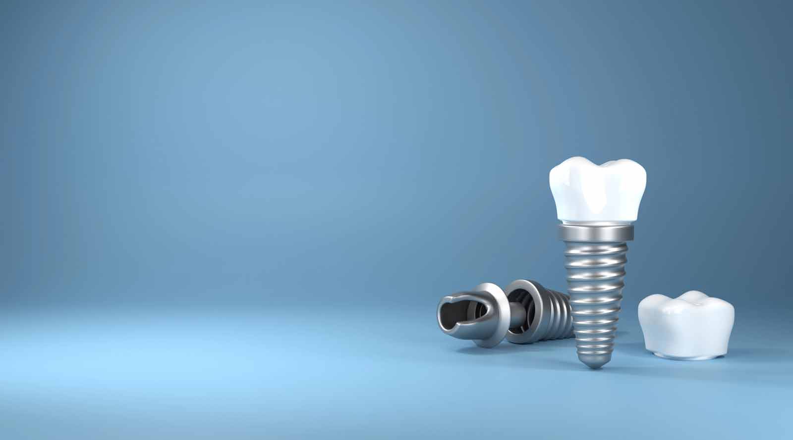 Model of a dental implant screw with a crown